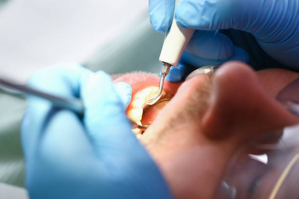 Best Emergency Tooth Extraction in Coal Grove, OH